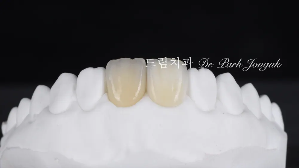 A case combining a no-prep veneer with an all-ceramic crown redo