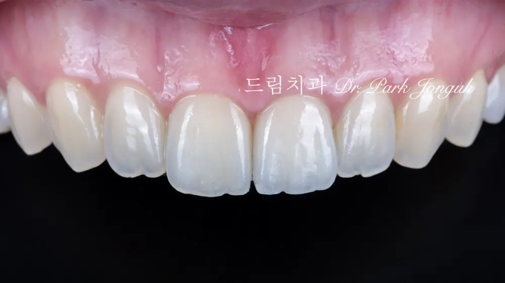A case combining a no-prep veneer with an all-ceramic crown redo