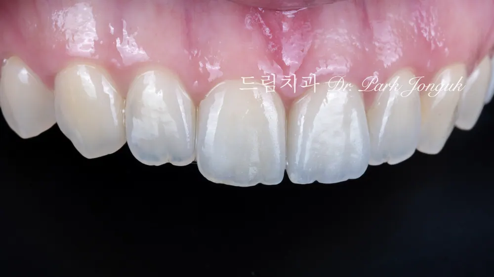A case combining a no-prep veneer with an all-ceramic crown redo