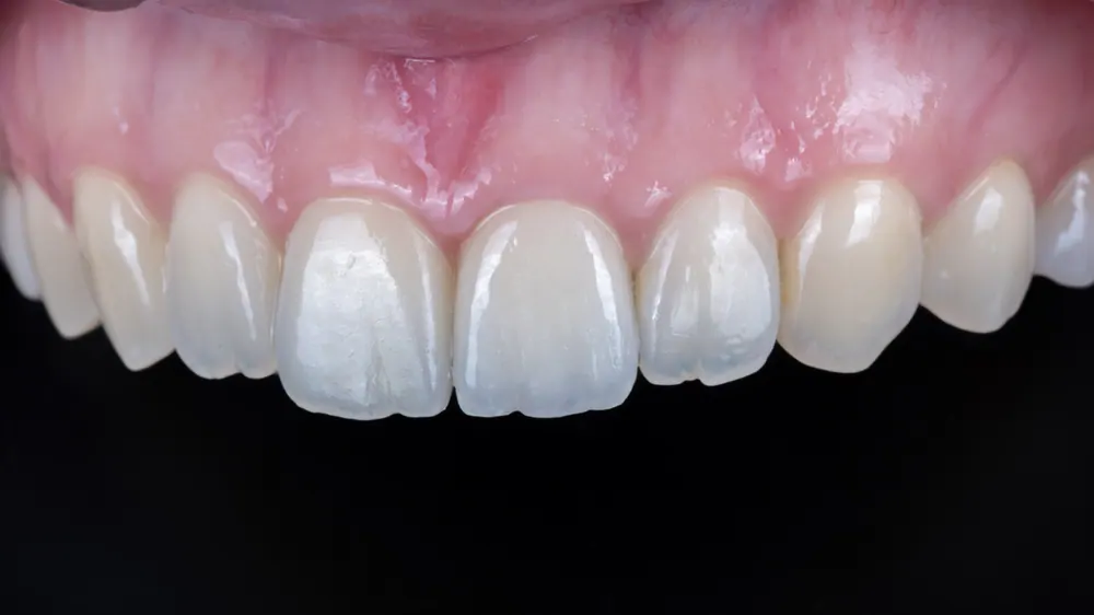 A case combining a no-prep veneer with an all-ceramic crown redo