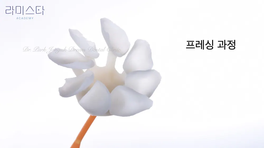 คลินิกวีเนียร์คังนัมที่ทำได้ดี วีเนียร์ที่เป็นธรรมชาติ