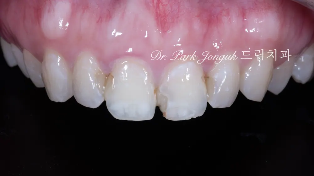 Front tooth cavity, front tooth resin, all-ceramic crown