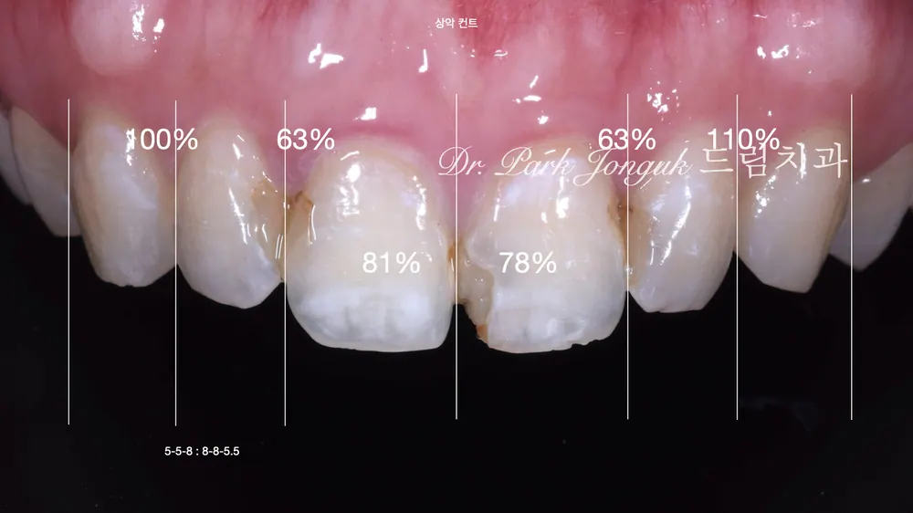 Front tooth cavity, front tooth resin, all-ceramic crown