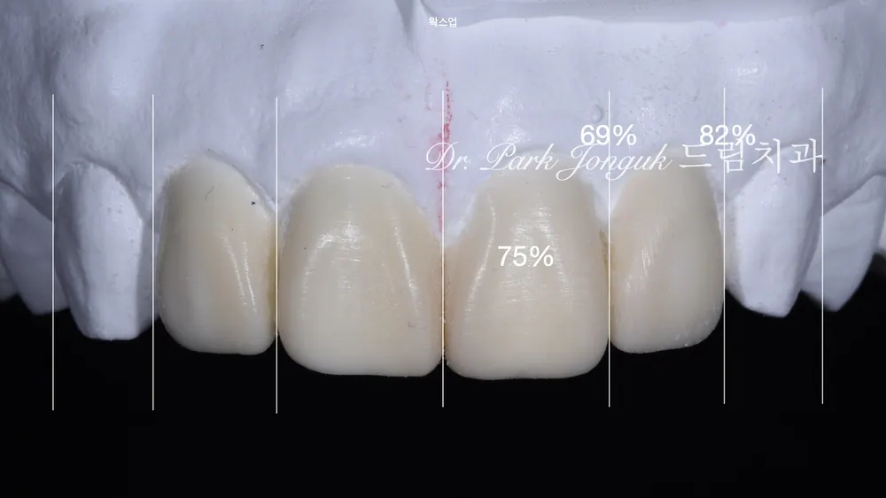 Front tooth cavity, front tooth resin, all-ceramic crown