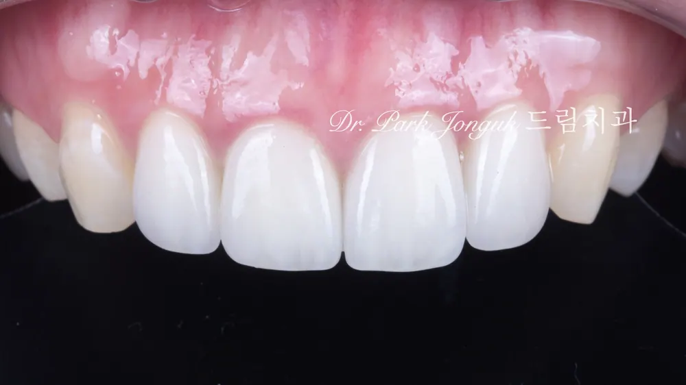 Front tooth cavity, front tooth resin, all-ceramic crown