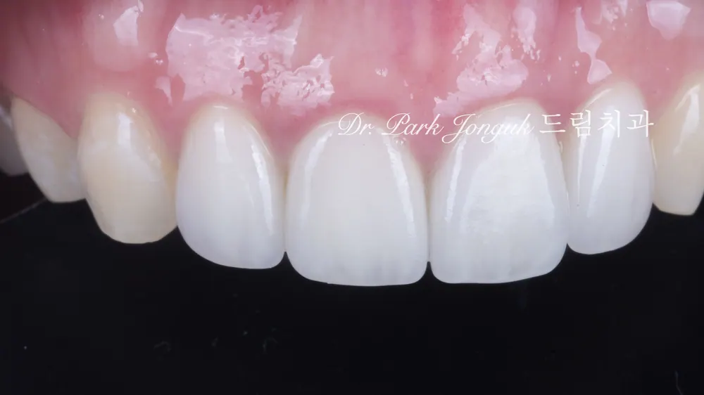 Front tooth cavity, front tooth resin, all-ceramic crown