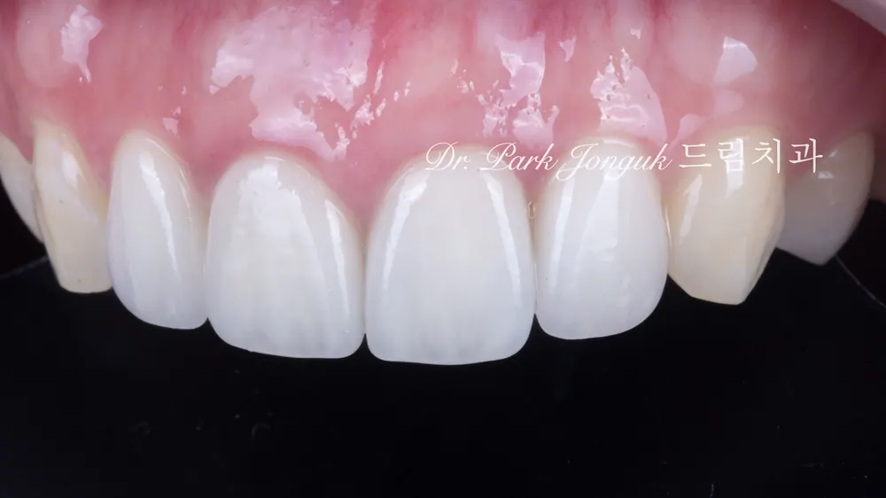 Front tooth cavity, front tooth resin, all-ceramic crown