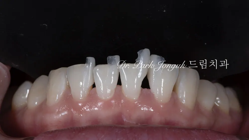 치아 사이 공간 무삭제 라미네이트