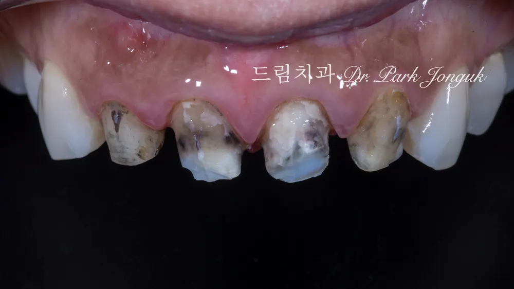 การรักษาซ้ำครอบฟันเซรามิกล้วนและวีเนียร์ที่แตกหัก