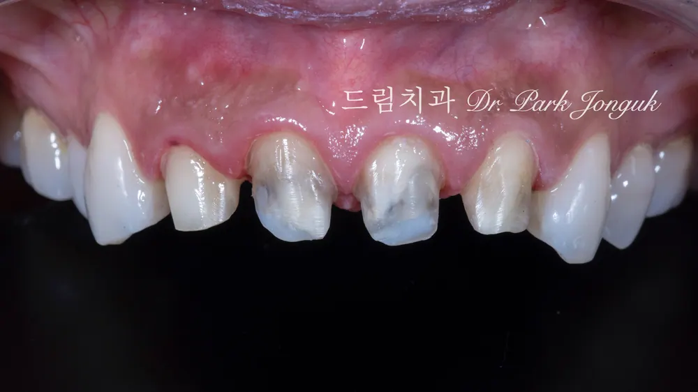การรักษาซ้ำครอบฟันเซรามิกล้วนและวีเนียร์ที่แตกหัก