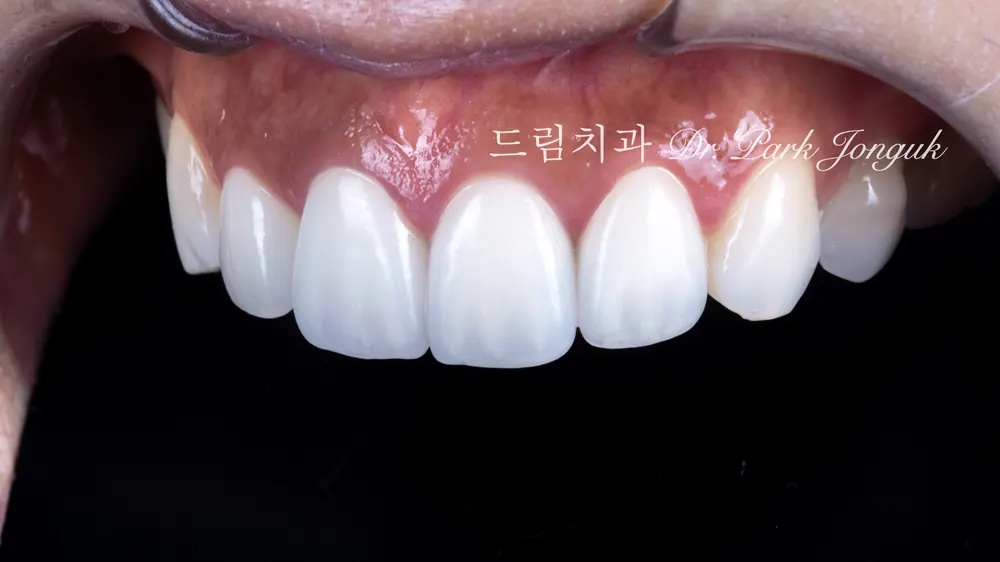 การรักษาซ้ำครอบฟันเซรามิกล้วนและวีเนียร์ที่แตกหัก
