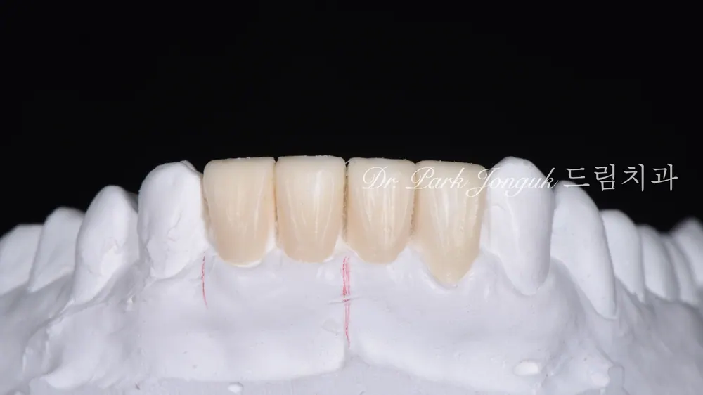 การรักษาซ้ำวีเนียร์: จากวีเนียร์ที่แตก สู่รอยยิ้มที่เป็นธรรมชาติ — ภาพที่ 4