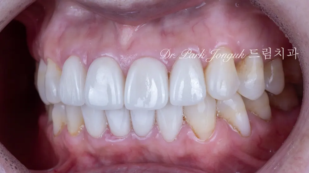 การรักษาซ้ำวีเนียร์: จากวีเนียร์ที่แตก สู่รอยยิ้มที่เป็นธรรมชาติ — ภาพที่ 8