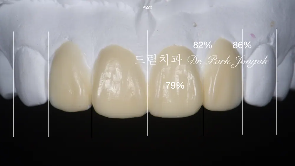 前歯ラミネート再治療