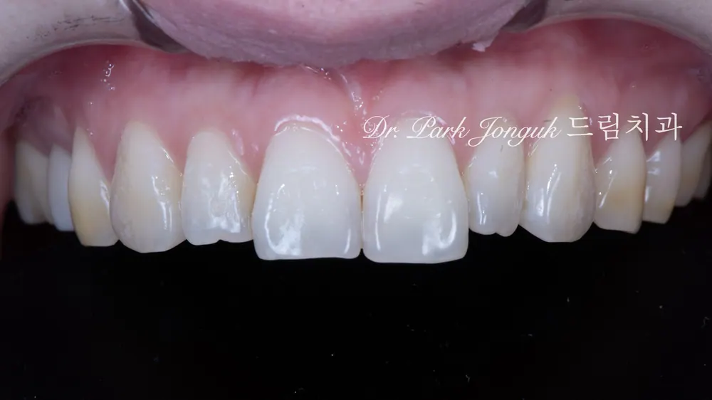 Peg lateral, feminine veneers