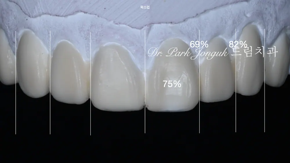 Peg lateral, feminine veneers