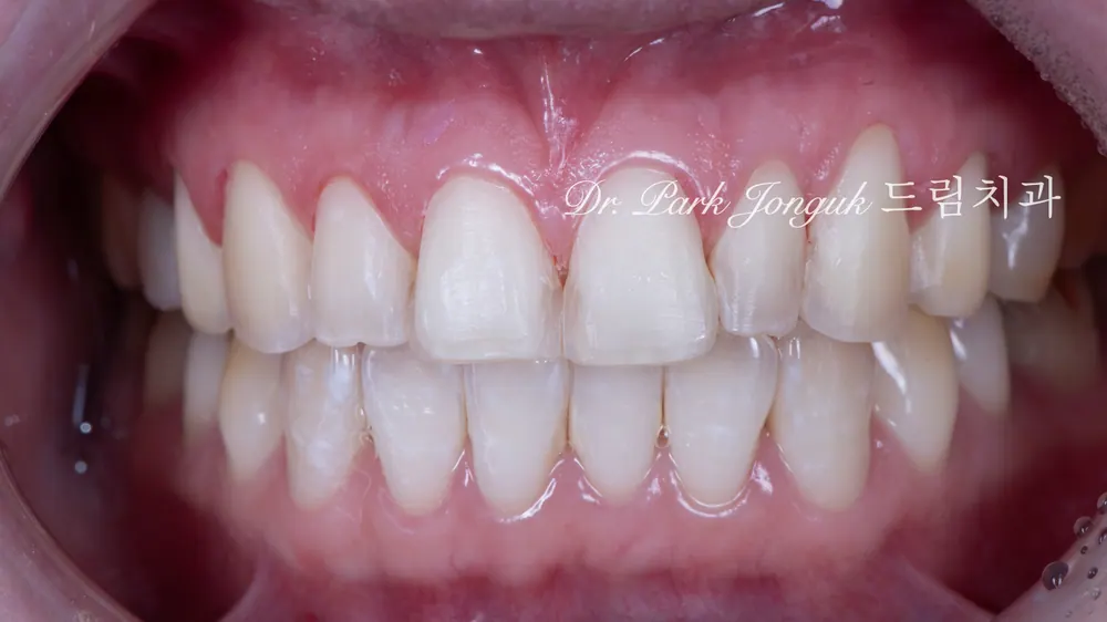 Peg lateral, feminine veneers