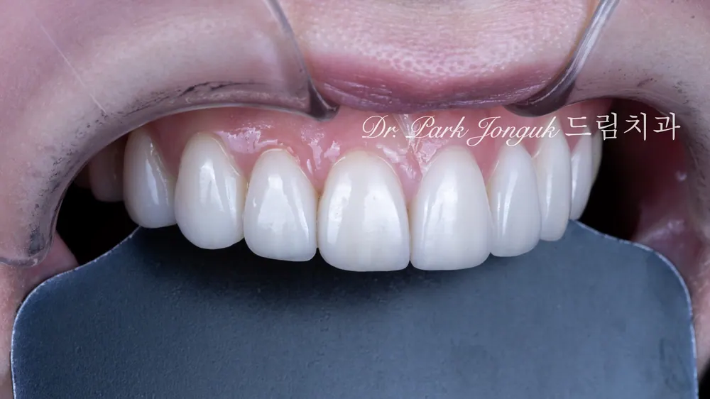 Peg lateral, feminine veneers