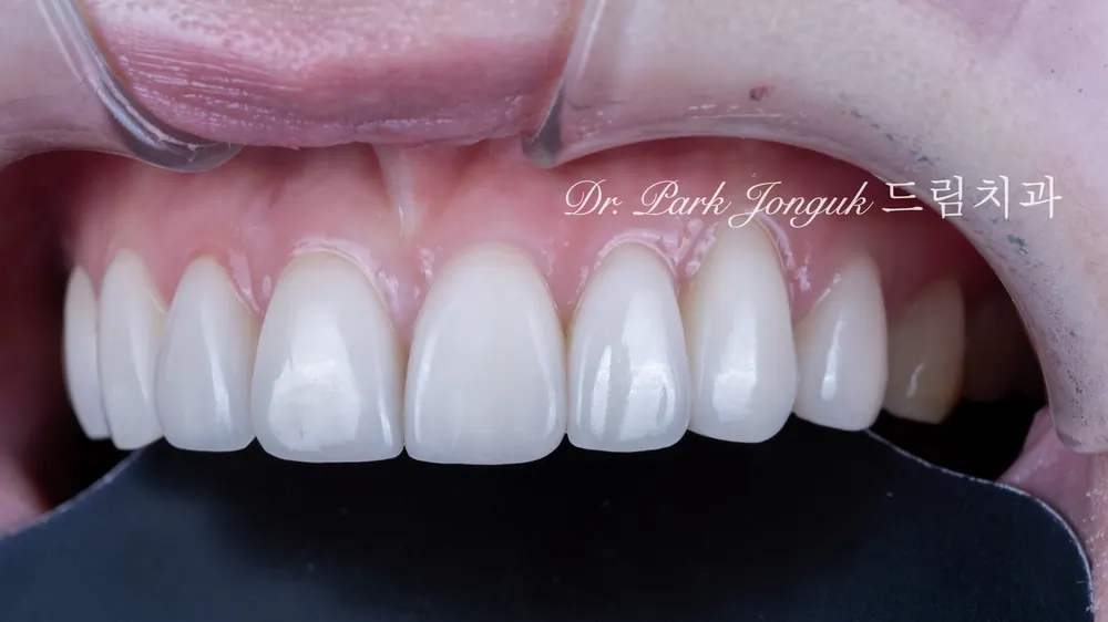 Peg lateral, feminine veneers