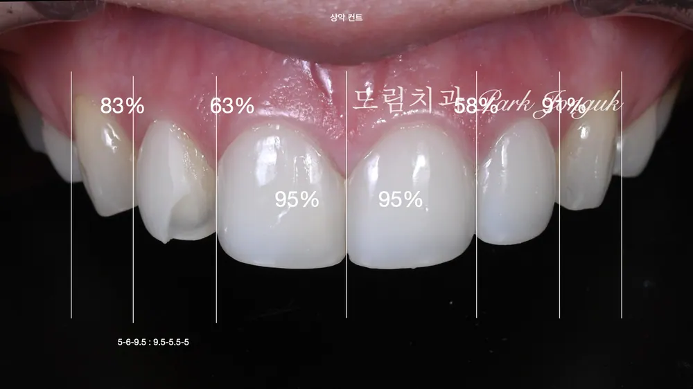 라미네이트 레이저 제거 재시술 재치료 자연스럽게