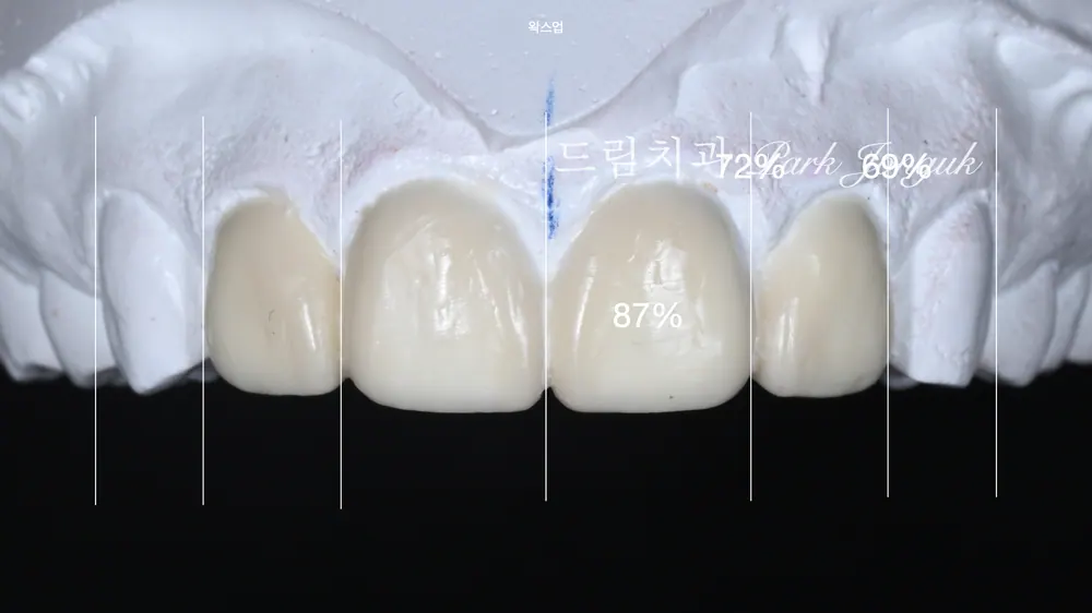 라미네이트 레이저 제거 재시술 재치료 자연스럽게
