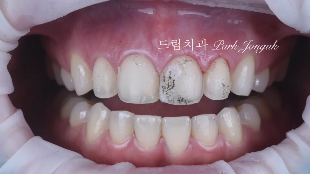 라미네이트 레이저 제거 재시술 재치료 자연스럽게