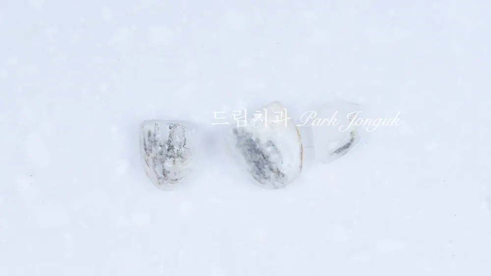 라미네이트 레이저 제거 재시술 재치료 자연스럽게