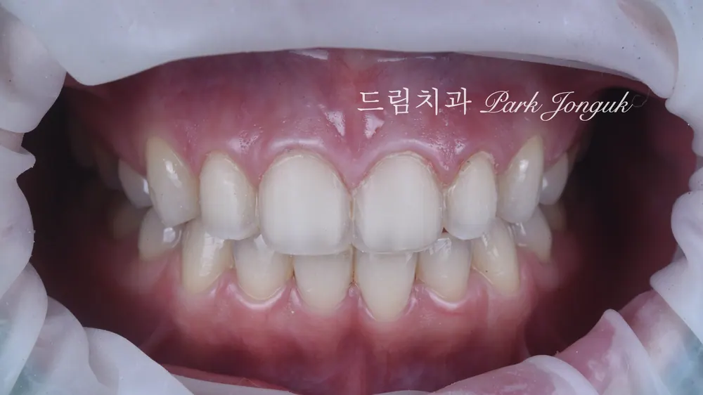 라미네이트 레이저 제거 재시술 재치료 자연스럽게
