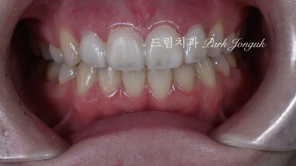 라미네이트 레이저 제거 재시술 재치료 자연스럽게