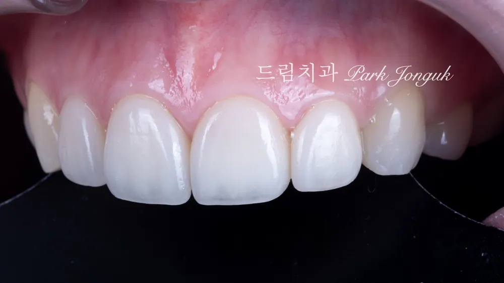 라미네이트 레이저 제거 재시술 재치료 자연스럽게