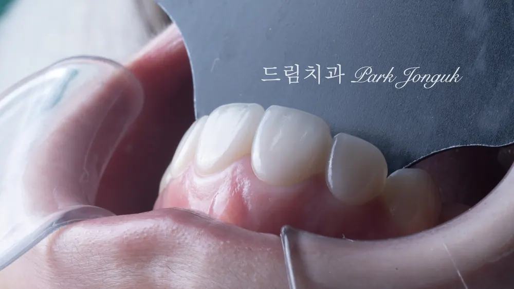 라미네이트 레이저 제거 재시술 재치료 자연스럽게