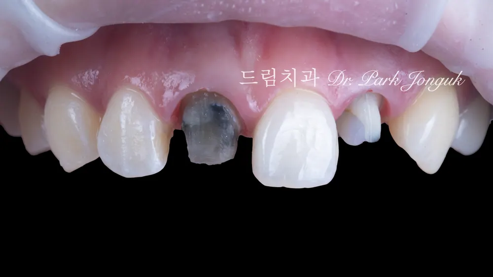 วีเนียร์ การรักษาซ้ำครอบฟันเซรามิกล้วน