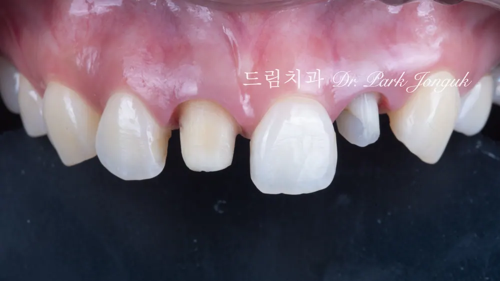 วีเนียร์ การรักษาซ้ำครอบฟันเซรามิกล้วน