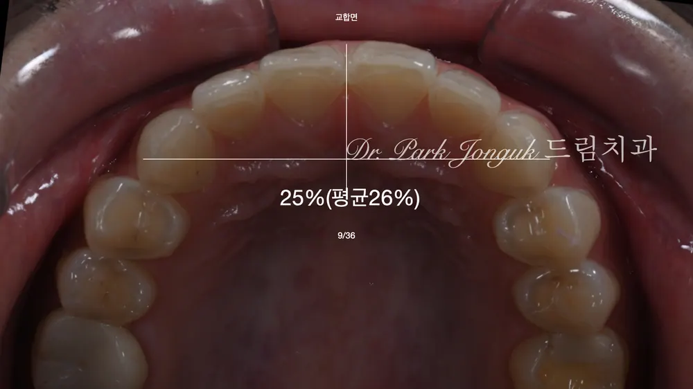 Виниры без обточки на передние зубы