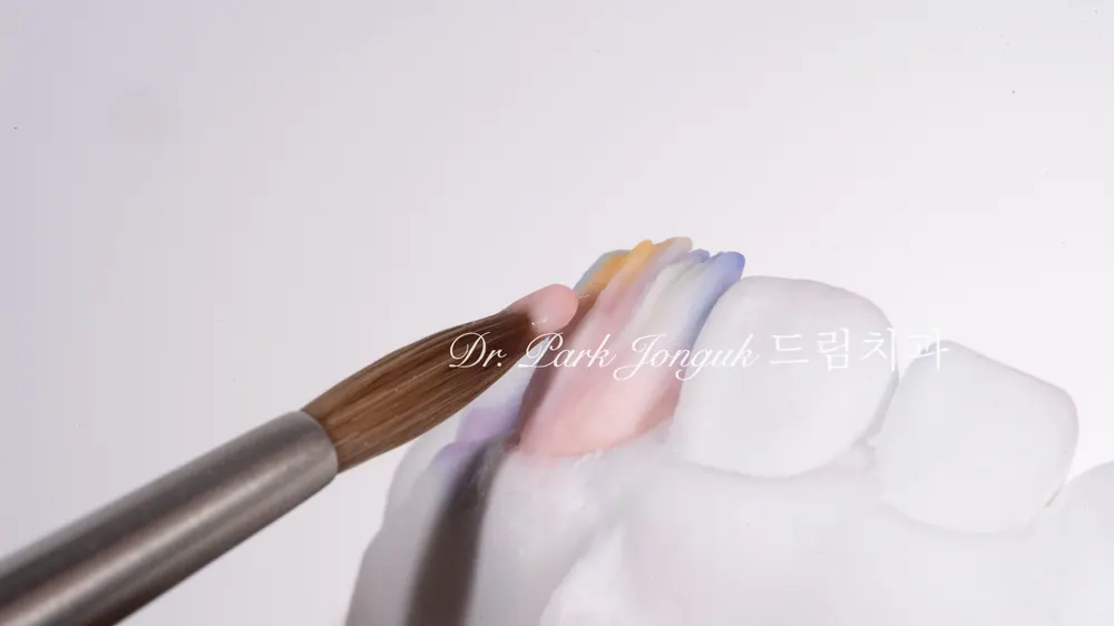 A meticulous front-tooth veneer fabrication process