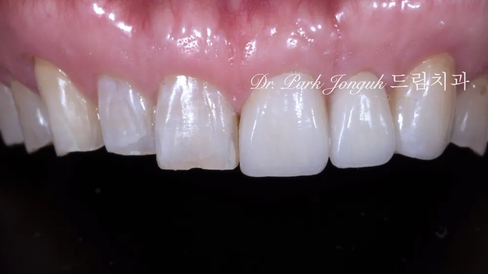 Preparing to set the veneers