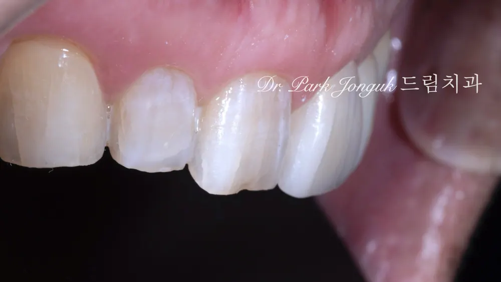 Preparing to set the veneers