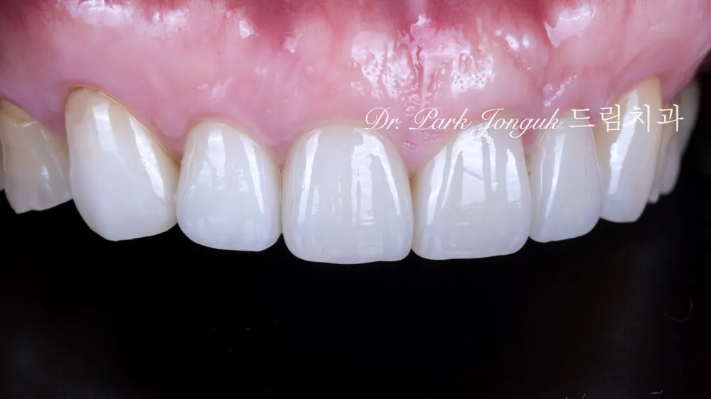 Front-tooth veneers on a patient in their 50s