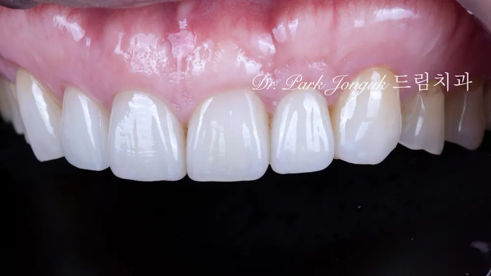 Front-tooth veneers on a patient in their 50s