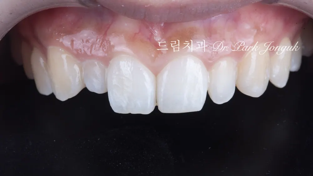 過小側切齒免磨牙陶瓷貼片