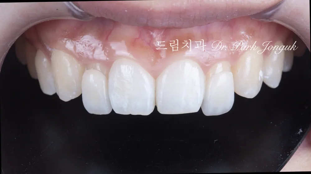 過小側切齒免磨牙陶瓷貼片