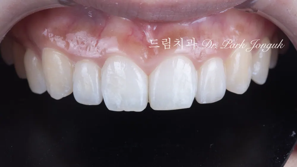 過小側切齒免磨牙陶瓷貼片