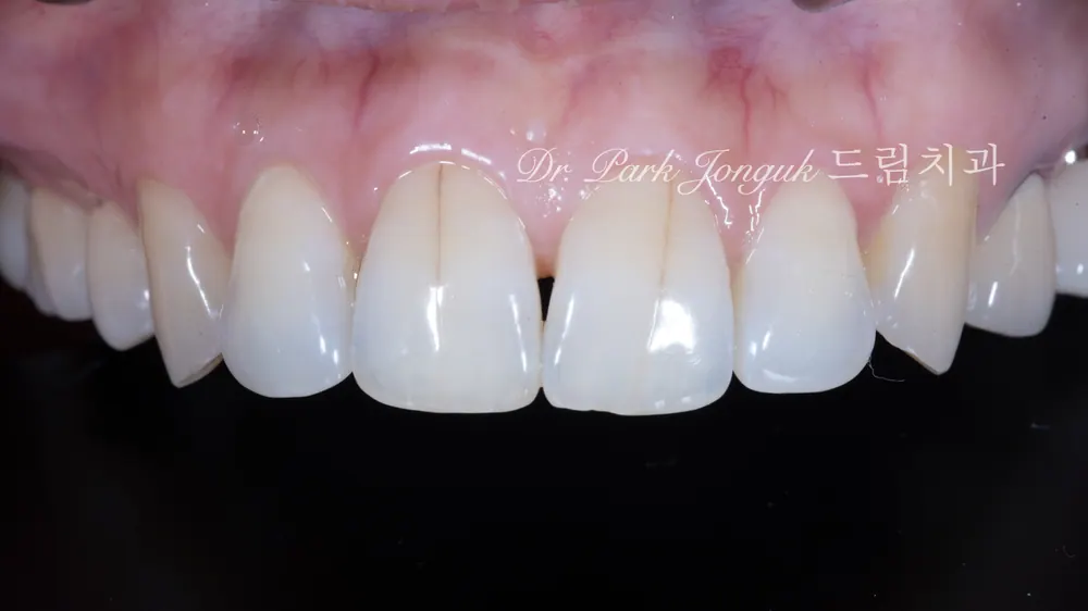 Veneer sứ Feldspar lá bạch kim tự nhiên ở răng cửa