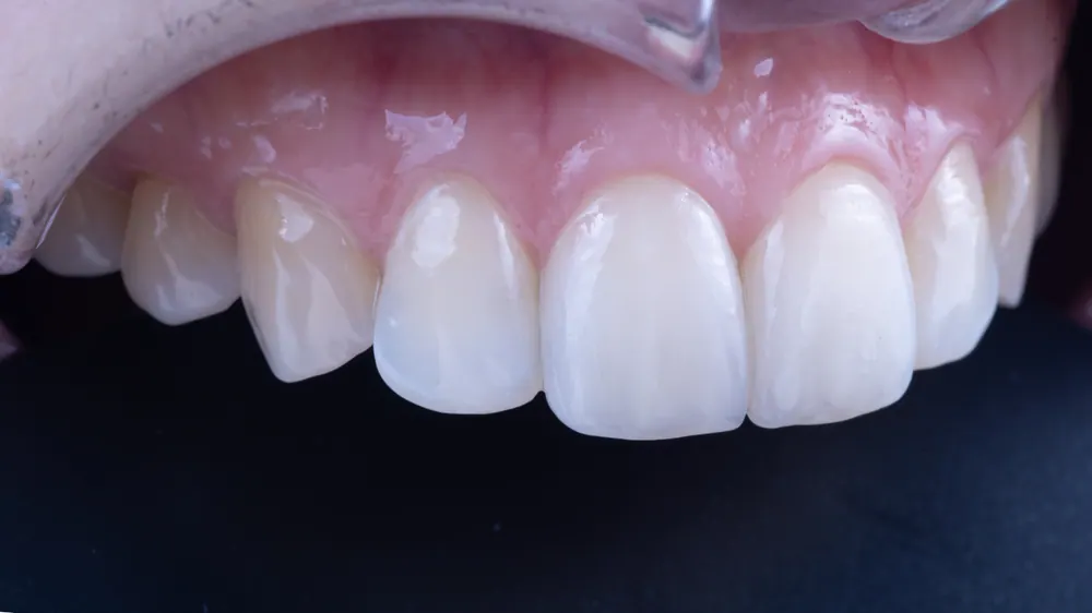 Veneer sứ Feldspar lá bạch kim tự nhiên ở răng cửa