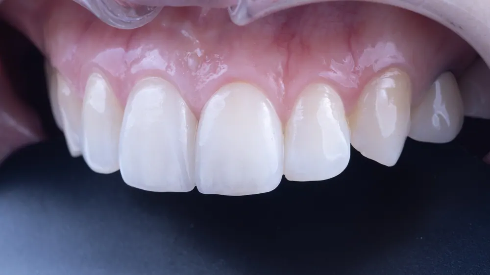 Veneer sứ Feldspar lá bạch kim tự nhiên ở răng cửa