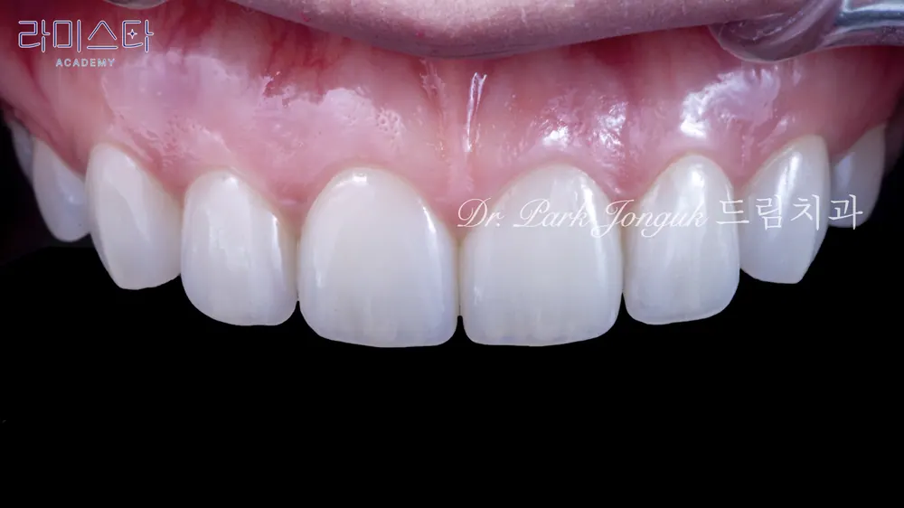 Veneer sứ Feldspar lá bạch kim tự nhiên ở răng cửa