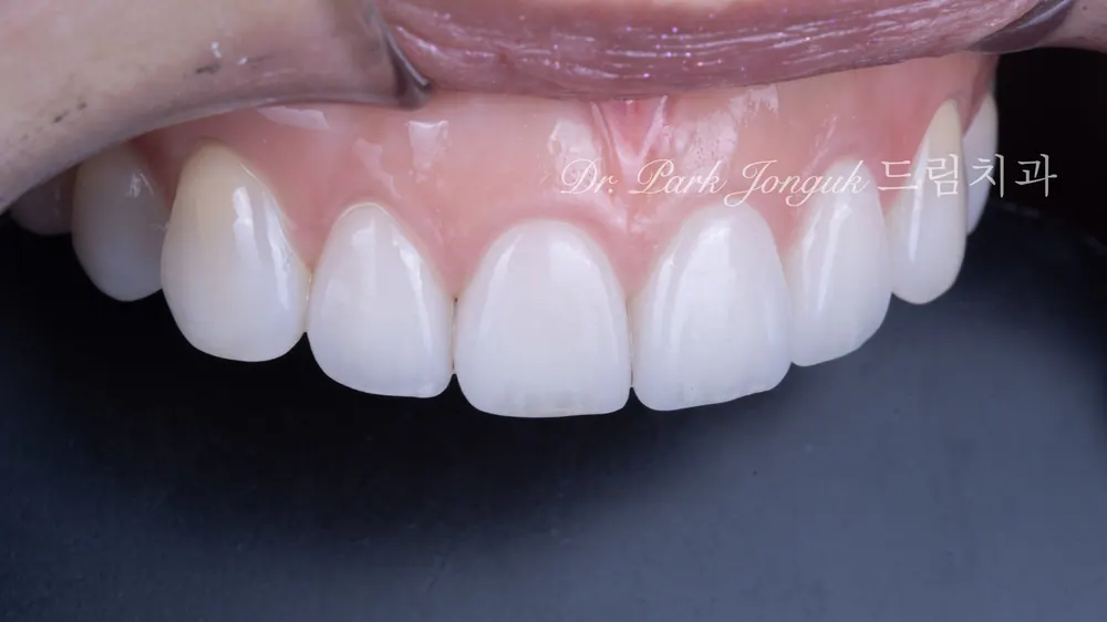 Veneer sứ Feldspar lá bạch kim tự nhiên ở răng cửa