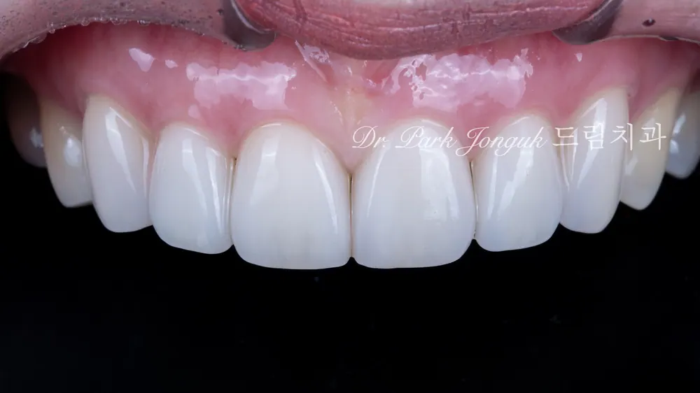 Veneer sứ Feldspar lá bạch kim tự nhiên ở răng cửa