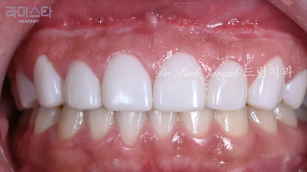 Veneer trông gượng gạo, giả tạo như kẹo cao su Xylitol