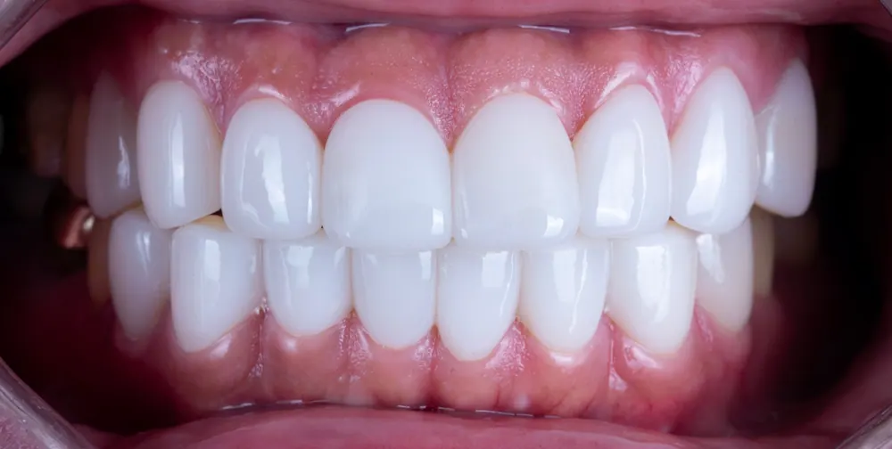 Veneer trông gượng gạo, giả tạo như kẹo cao su Xylitol